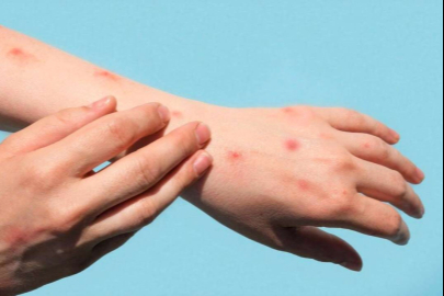 Maymun Çiçeği virüsü pandemi etkisi oluşturur mu? Korunmak için neler yapılmalı
