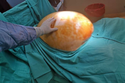 Yumurtalıklarındaki 23 kiloluk kitle operasyonla çıkarıldı; doktorlar da şaşırdı