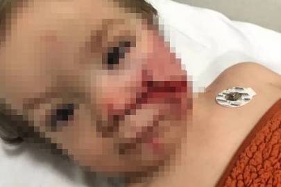 Ankara'da pitbull dehşeti: Çocuğun yüzü paramparça oldu