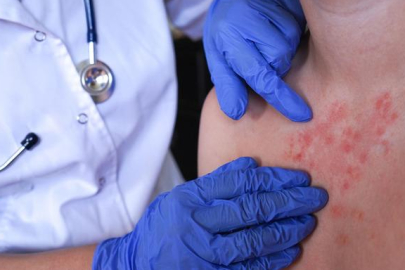 Vakalar dünyada artıyor: İngiltere MPOX virüsü alarmı verdi! Bu yeni bir varyant